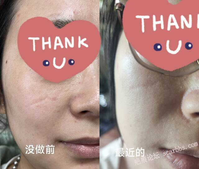 Plasma做了七次还是顶光明显还可以继续做吗？