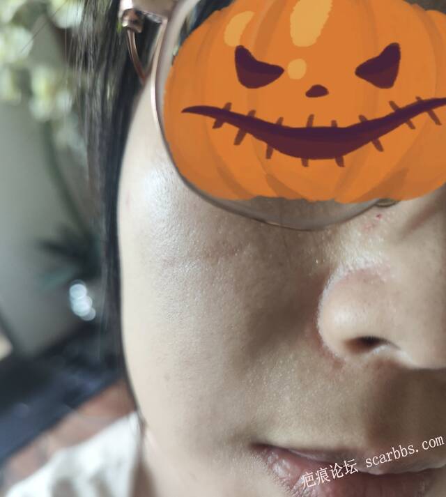 Plasma做了七次还是顶光明显还可以继续做吗？ 