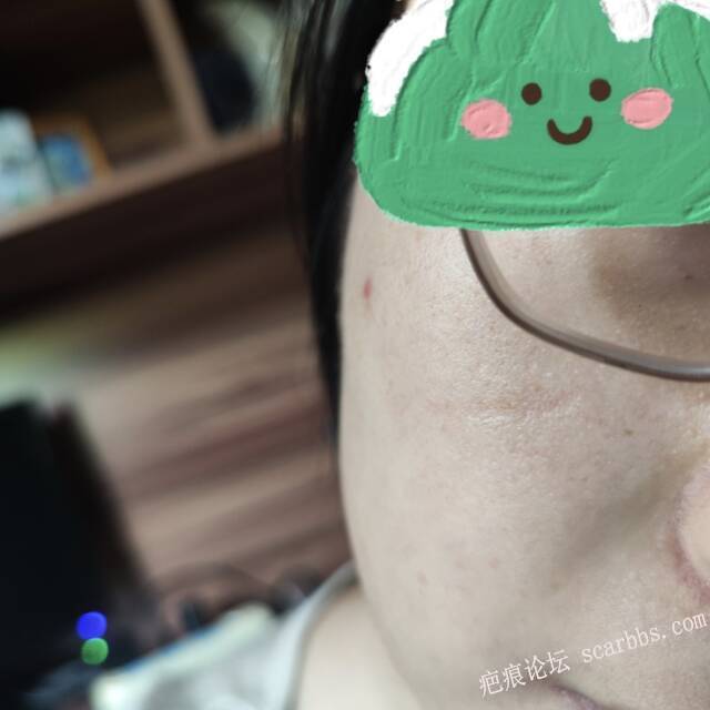 凹陷线性疤痕打了7次离子束还可以继续做吗？ 