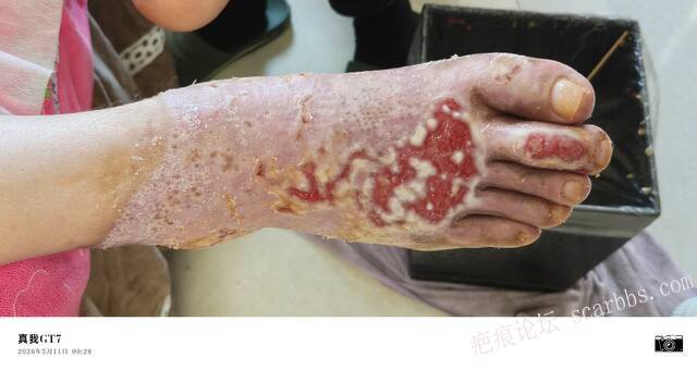 李高令2026年，接治又一个黑龙江哈尔滨，51岁，下肢瘫痪的病人… 