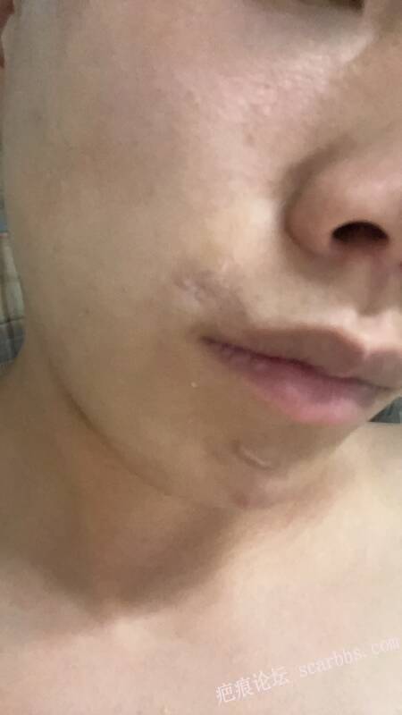 下颌处疤痕，大哥们帮我看看 