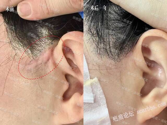 疤痕修复