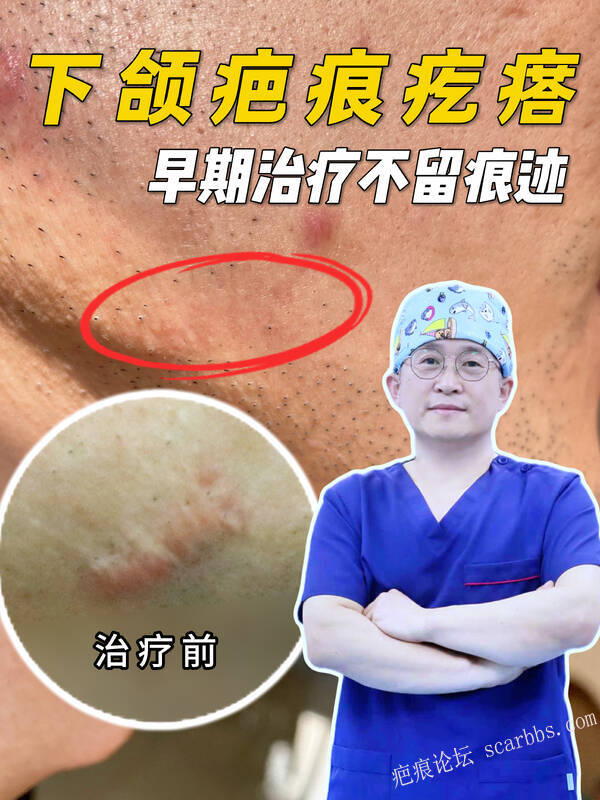 下颌疤痕疙瘩｜早期治疗效果更好