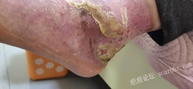 李高令2026年，接治又一个黑龙江哈尔滨，51岁，下肢瘫痪的病人… 
