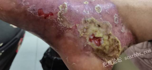 李高令2026年，接治又一个黑龙江哈尔滨，51岁，下肢瘫痪的病人… 