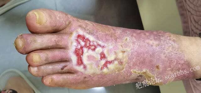 李高令2026年，接治又一个黑龙江哈尔滨，51岁，下肢瘫痪的病人… 