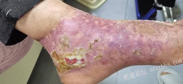 李高令2026年，接治又一个黑龙江哈尔滨，51岁，下肢瘫痪的病人… 
