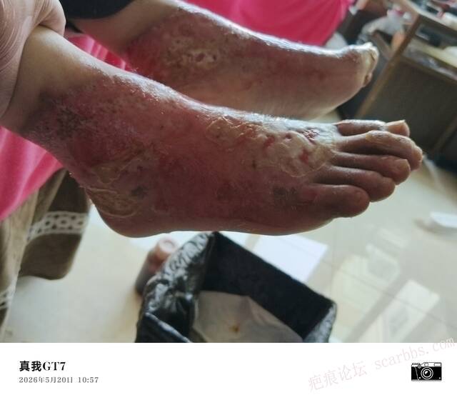 李高令2026年，接治又一个黑龙江哈尔滨，51岁，下肢瘫痪的病人… 