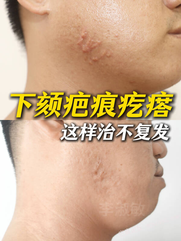 四年多的疤痕疙瘩，才保守治疗一次就平软了