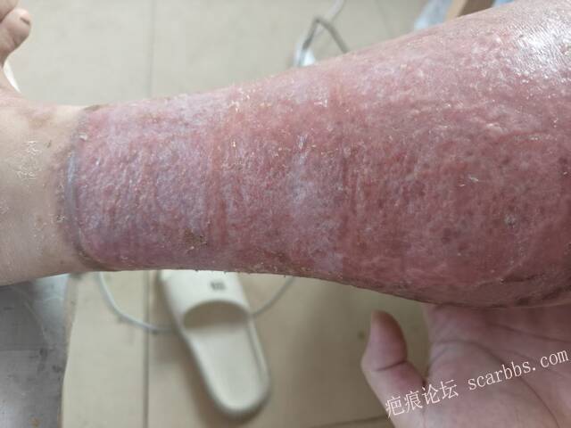 2026年，李高令接治已下植皮令的患者(荷泽) 