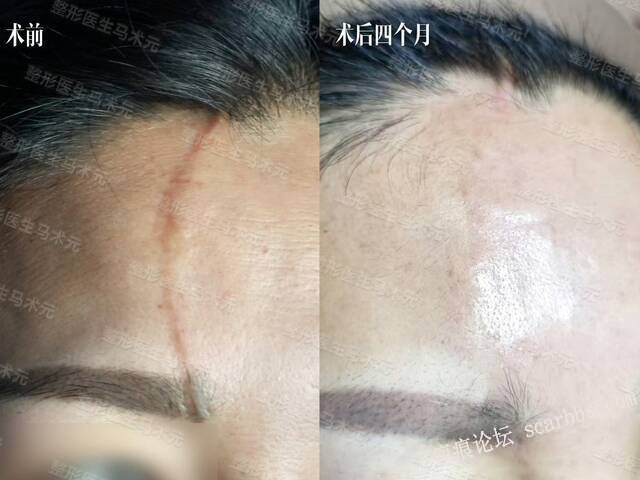 疤痕修复
