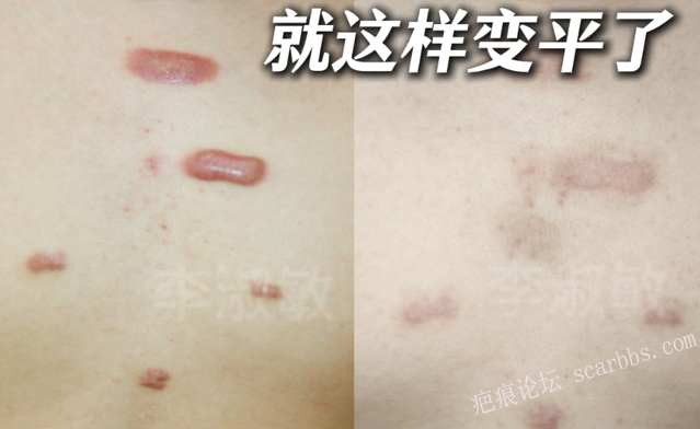 3年里疤痕疙瘩越长越凶，现在终于压住了