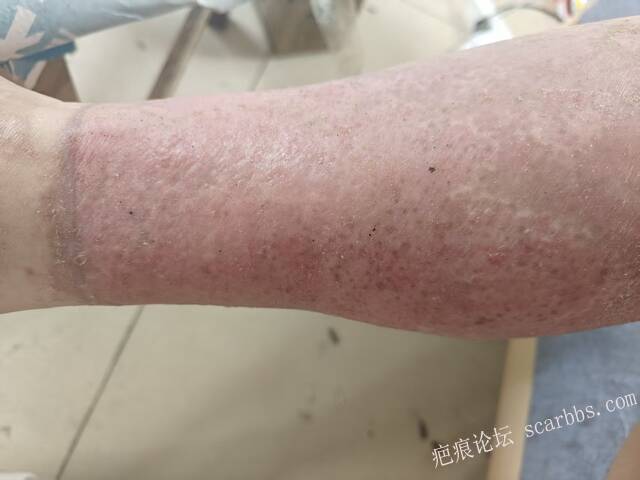 2026年，李高令接治已下植皮令的患者(荷泽) 