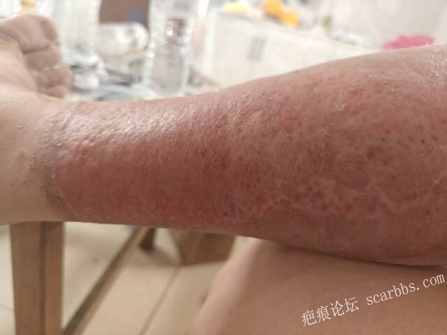 2026年，李高令接治已下植皮令的患者(荷泽) 