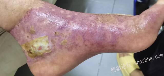 李高令2026年，接治又一个黑龙江哈尔滨，51岁，下肢瘫痪的病人… 