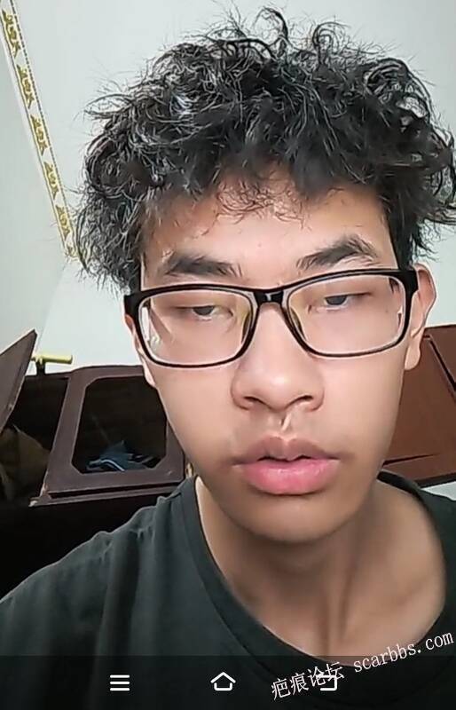 人中疤痕