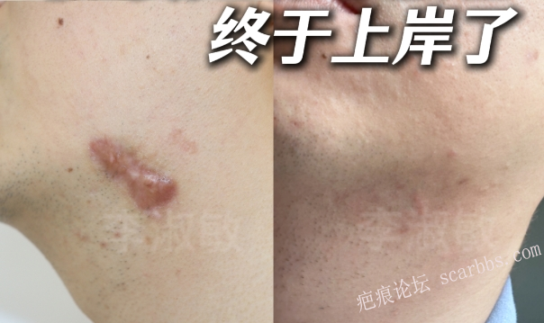 十几年疤痕疙瘩彻底变平变软