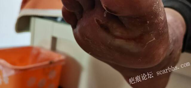 李高令2026年，接治又一个黑龙江哈尔滨，51岁，下肢瘫痪的病人… 