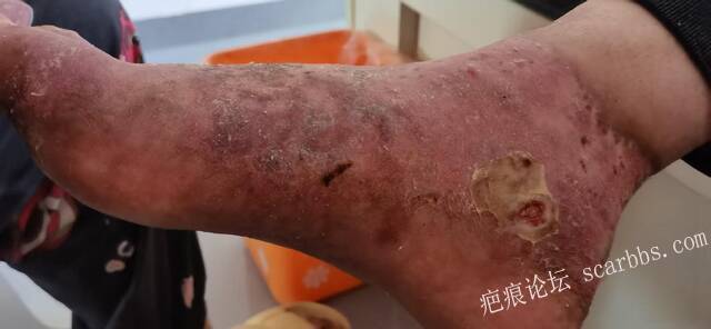 李高令2026年，接治又一个黑龙江哈尔滨，51岁，下肢瘫痪的病人… 