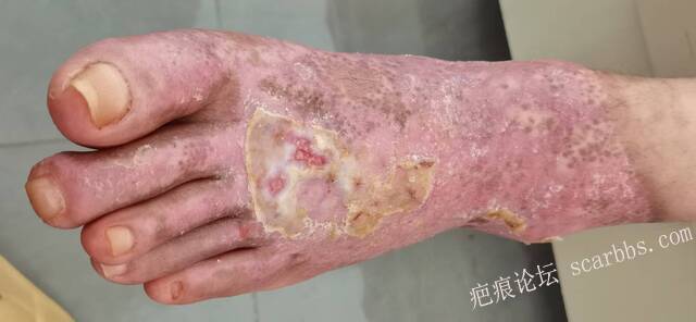 李高令2026年，接治又一个黑龙江哈尔滨，51岁，下肢瘫痪的病人… 