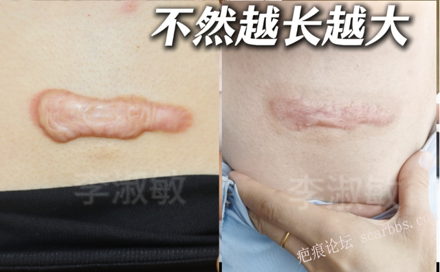 打针+预防照射，前胸疤痕疙瘩成功上岸