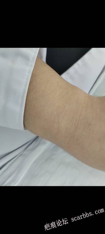 抓伤疤已经9个月了