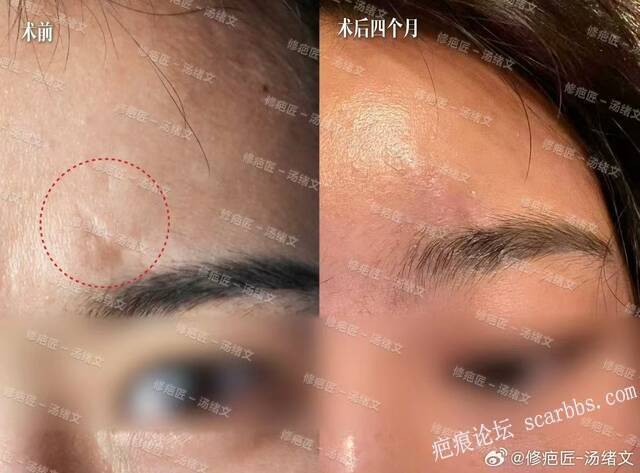 疤痕修复术后4个月
