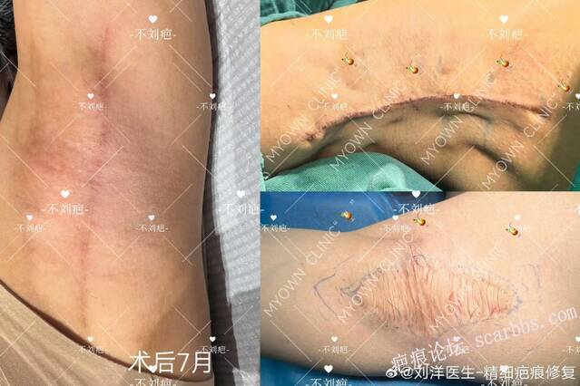 腋下疤痕修复
