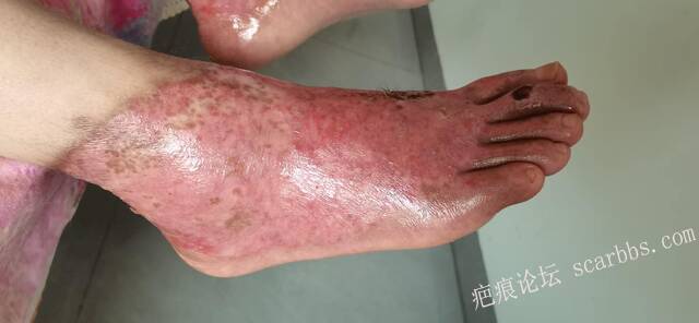 李高令2026年，接治又一个黑龙江哈尔滨，51岁，下肢瘫痪的病人… 