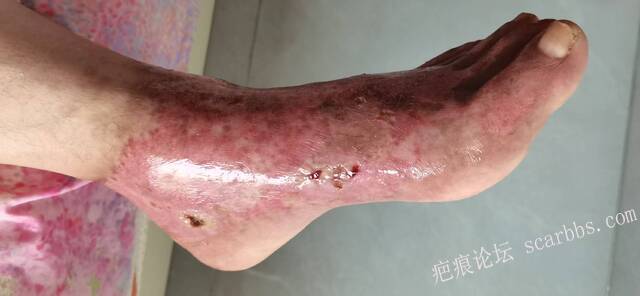 李高令2026年，接治又一个黑龙江哈尔滨，51岁，下肢瘫痪的病人… 