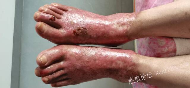 李高令2026年，接治又一个黑龙江哈尔滨，51岁，下肢瘫痪的病人… 