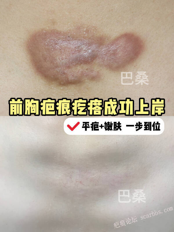 前胸疤痕疙瘩｜平疤嫩肤双重修复