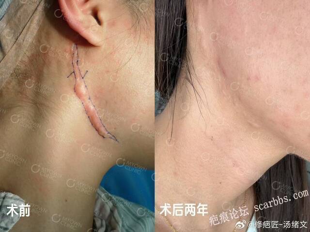 疤痕修复