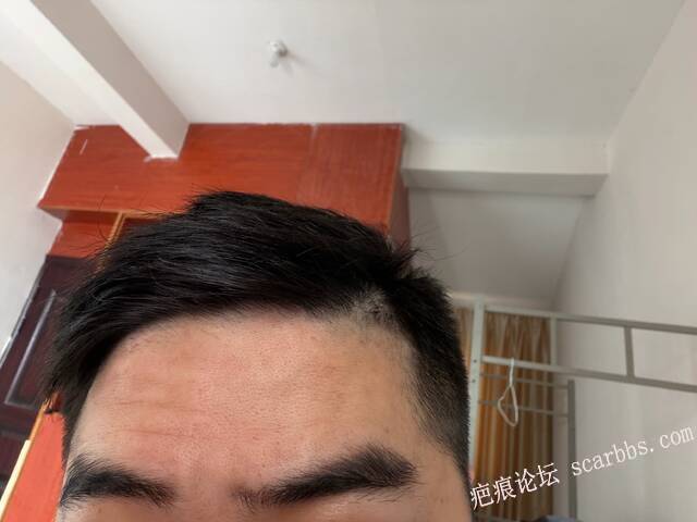 额头疤痕术后两年零三个月恢复情况 