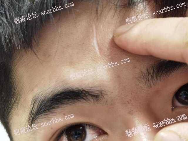 额头切缝六年，侧面光凸起明显 
