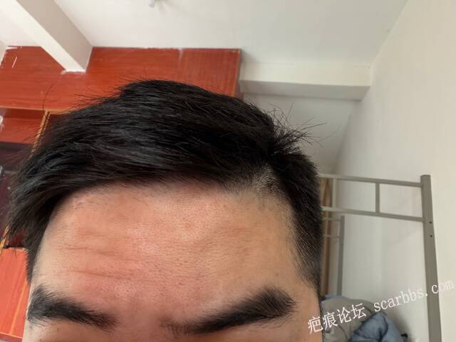 额头切缝六年，侧面光凸起明显 