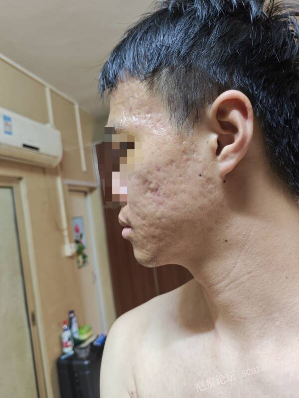 大面积滚轮型痘坑该如何改善？ 