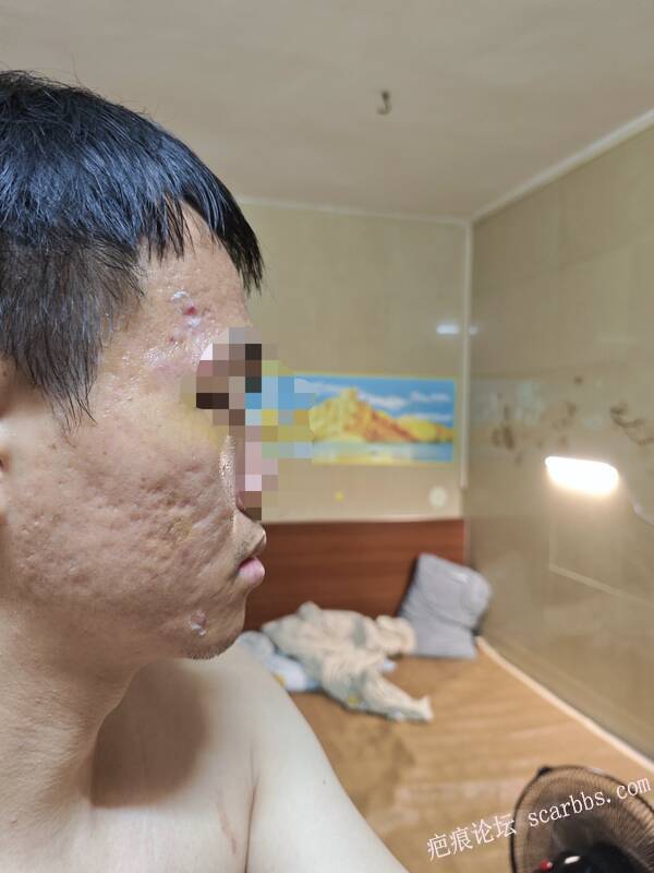 大面积滚轮型痘坑该如何改善？ 