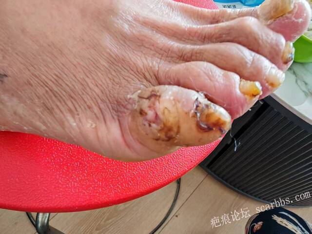 李高令接治糖尿病…医生说要载肢的患者（青岛） 
