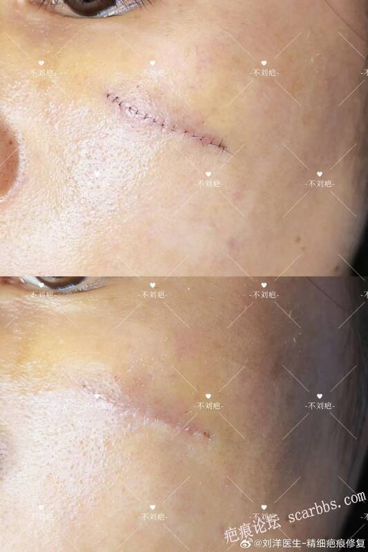 疤痕修复拆线即刻