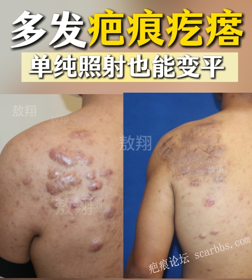 密密麻麻的疤痕疙瘩，终于平软下去了