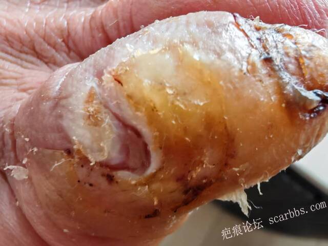 李高令接治糖尿病…医生说要截肢的患者（青岛） 