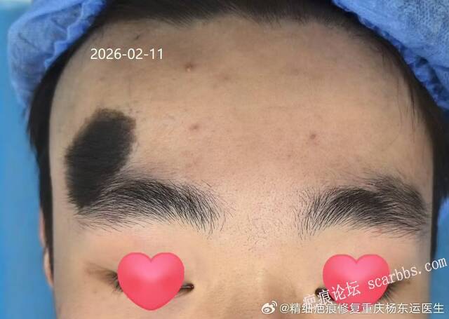 胎记切除 