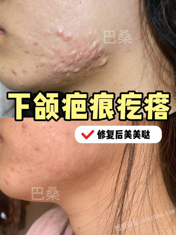 下颌疤痕疙瘩修复 早干预恢复更好