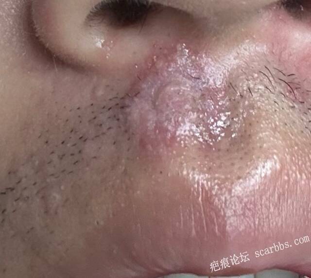 人中摔伤2星期，有没有什么修复方法？ 