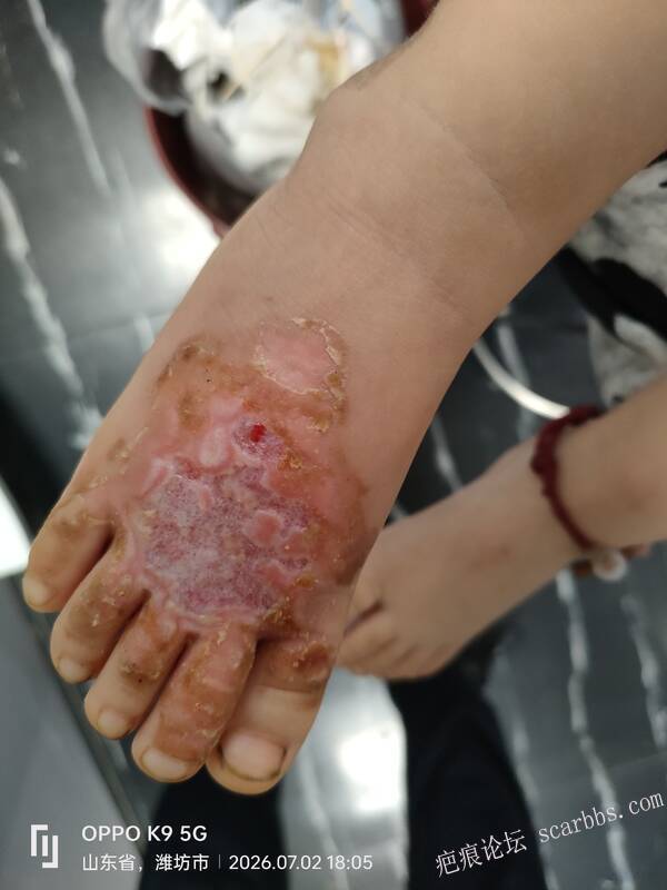 2026年李高令接治维坊脚受伤的孩子 