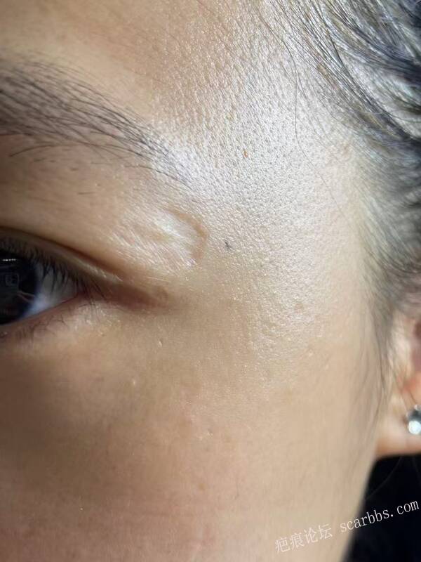 陈旧性眼周凹陷疤痕该如何治疗 凹陷疤痕,摔伤疤痕,额头疤痕,眼周凹陷疤痕