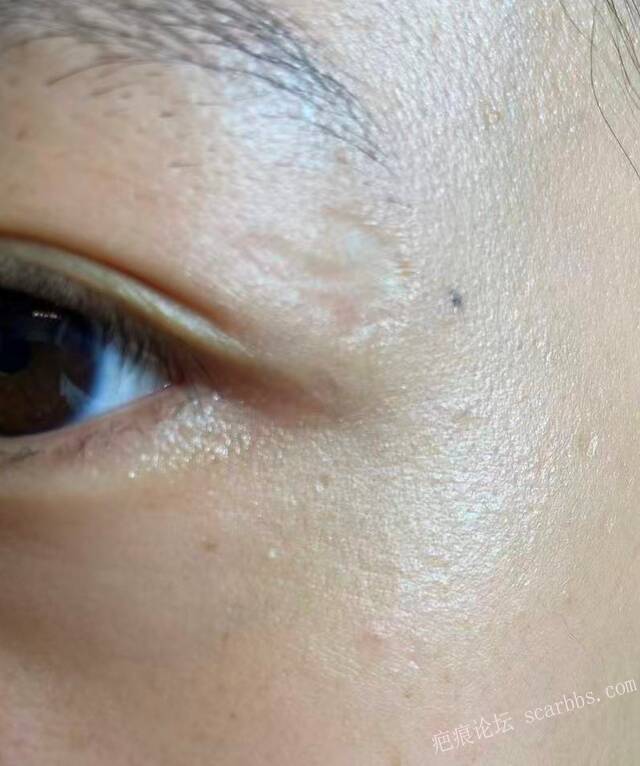 陈旧性眼周凹陷疤痕该如何治疗