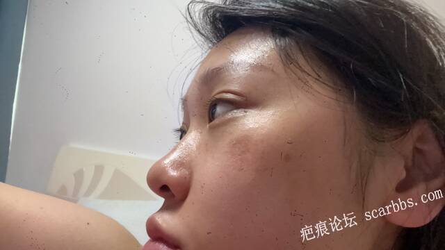 多年的深凹陷疤痕，求助怎么去除