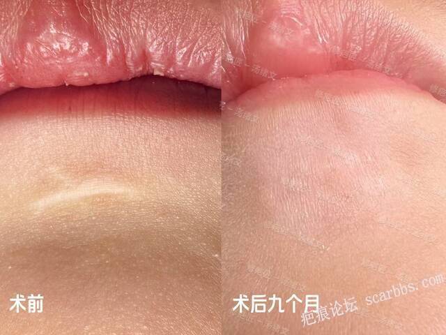 疤痕修复